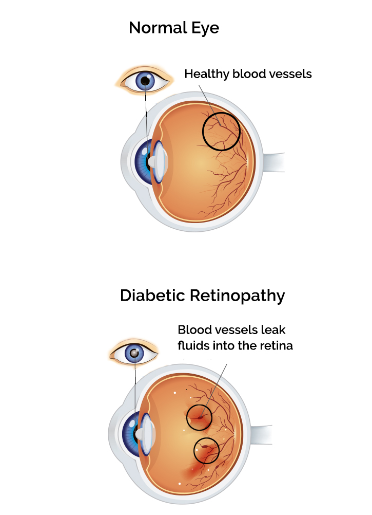 noraml eye and an eye with diabetic retinopathy